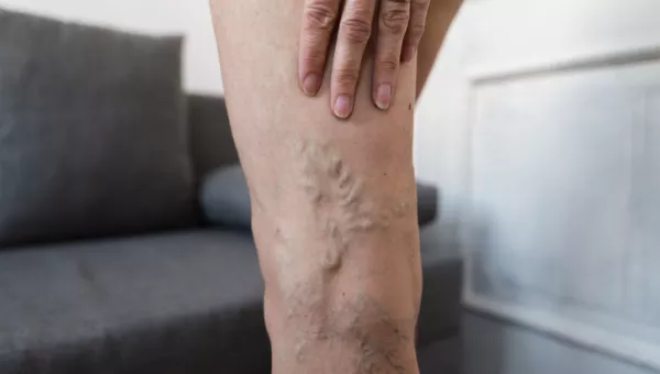 veins in lady's leg