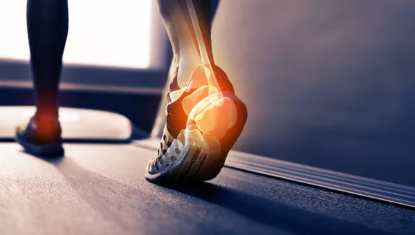 A person walking with an x-rayed foot
