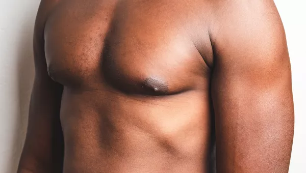 Male Breast Reduction patient
