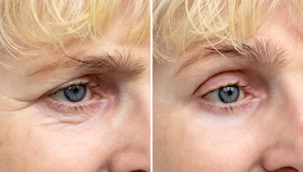 Bleph/ brow lift